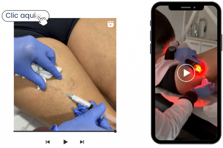 Vídeo escleroterapia: tratamiento de varices y arañas vasculares inyectando una solución esclerósante
