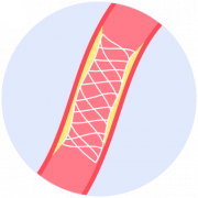 Stent en arteria