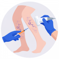 Radiofrecuencia endovenosaRadiofrecuencia endovenosa