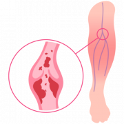 Trombosis